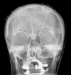 Two DBS probes shown in an X-ray of the skull