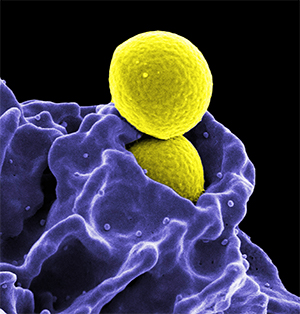 Image of a rippled neutrophil (in violet) swallowing up two round, yellow spheres (bacteria).