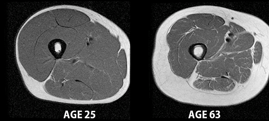 Black and white cross-sections of two human thighs. The one labeled 'age 25' has more muscle and less fat than the other labeled 'age 63'.