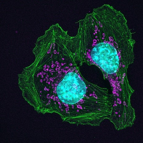Two cancer cells shown as irregular, oblong structures connected in two places. Each cell has a large blue circle in the center with small, scattered purple spots around it. 