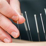 Acupuncture